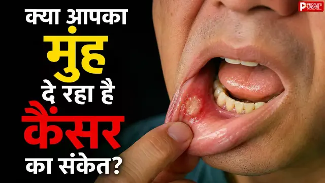 तंबाकू खाने वालों के लिए एक्सपर्ट की बड़ी चेतावनी, जानिए ओरल कैंसर के शुरुआती लक्षण