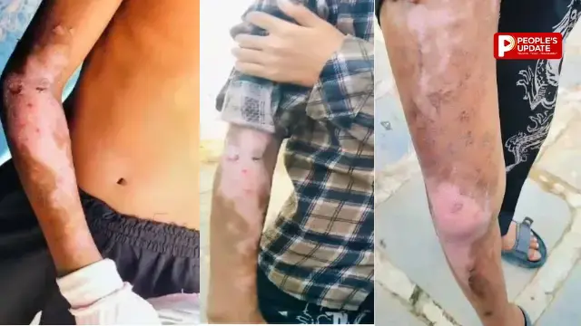 गरियाबंद के आदिवासी छात्रावास में बड़ी लापरवाही,गर्म दाल गिरने से 2 छात्र झुलसे, चेहरे तक जले