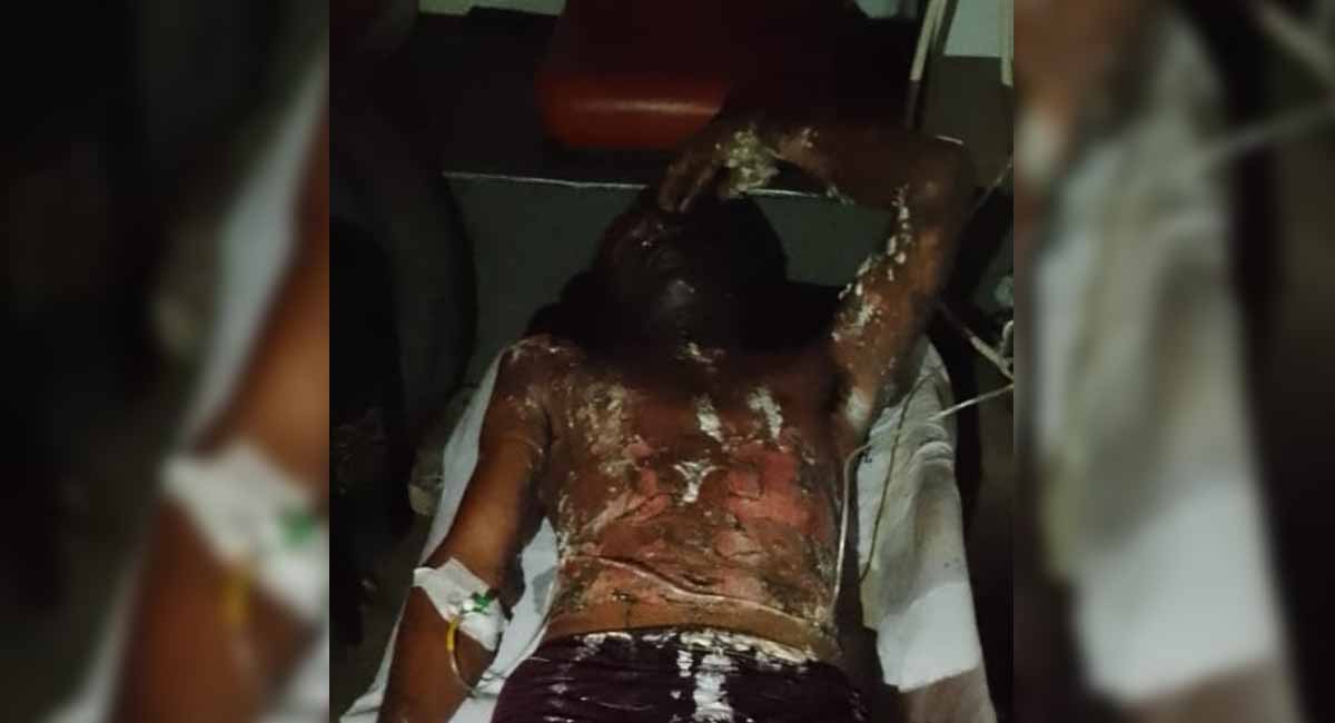 आग से झुलसे युवक की मौत, आरक्षक पर पेट्रोल डालकर आग लगाने का आरोप