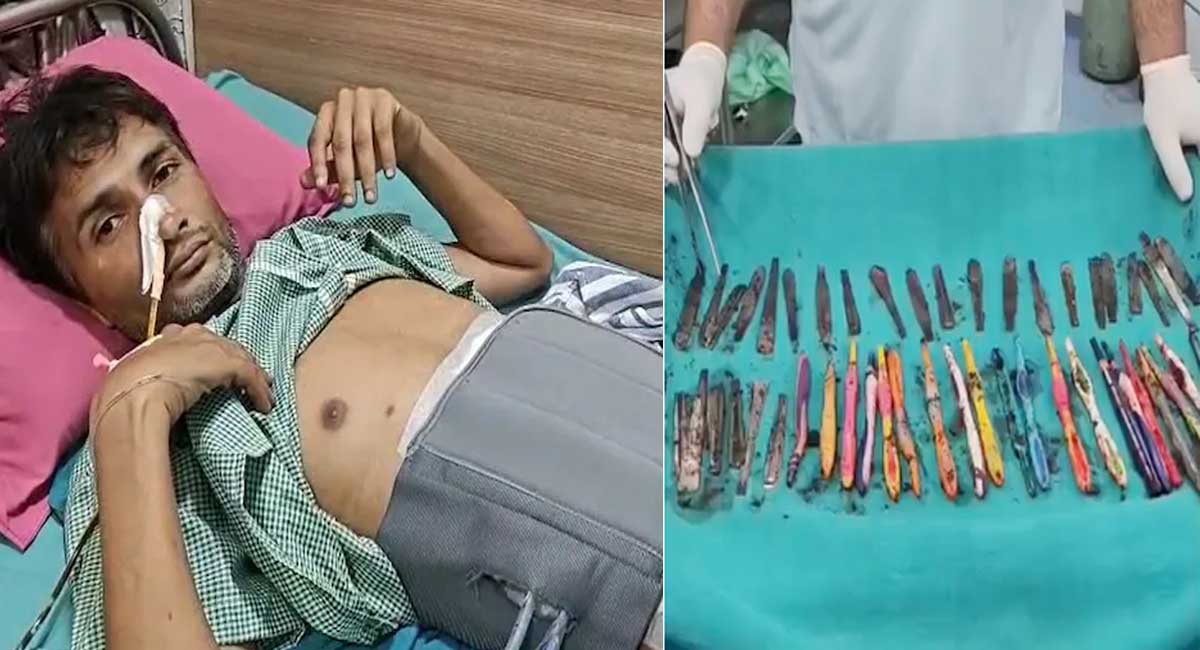 युवक के पेट से 29 चम्मच, 19 टूथब्रश और 2 बॉलपेन निकले, ऑपरेशन के दौरान डॉक्टर भी रह गए दंग