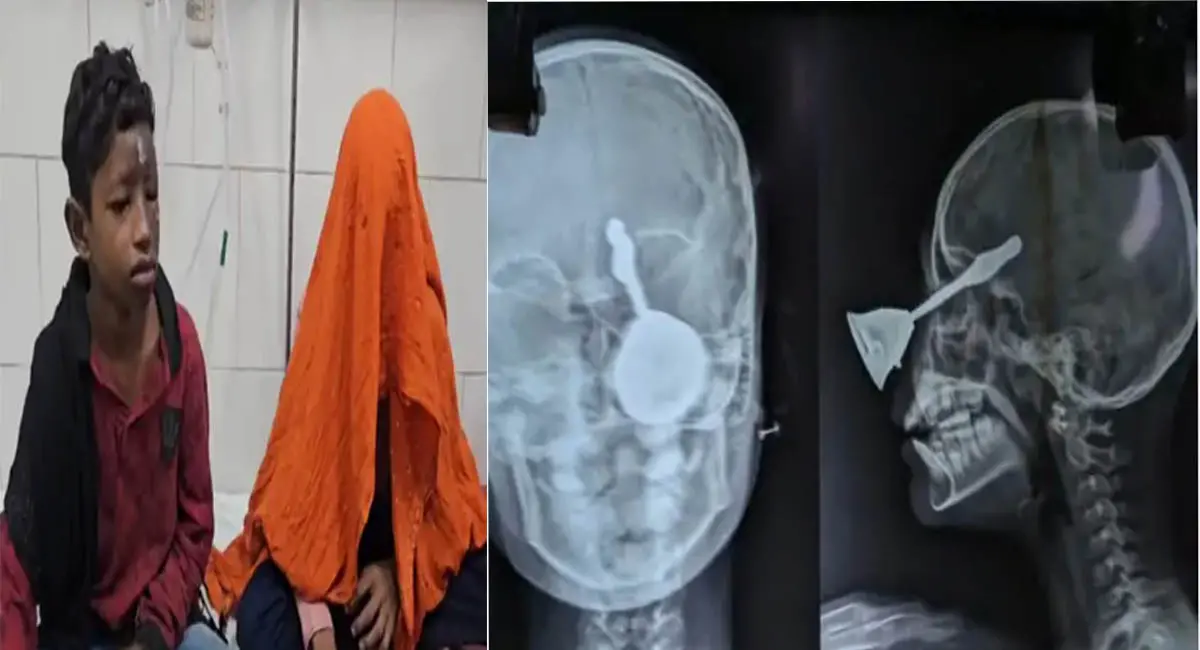 बिलासपुर में दर्दनाक हादसा... मासूम की आंख में घुसी पूजा की घंटी, हालत गंभीर