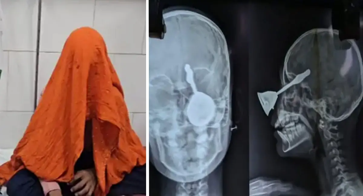 बिलासपुर में दर्दनाक हादसा... मासूम की आंख में घुसी पूजा की घंटी, हालत गंभीर