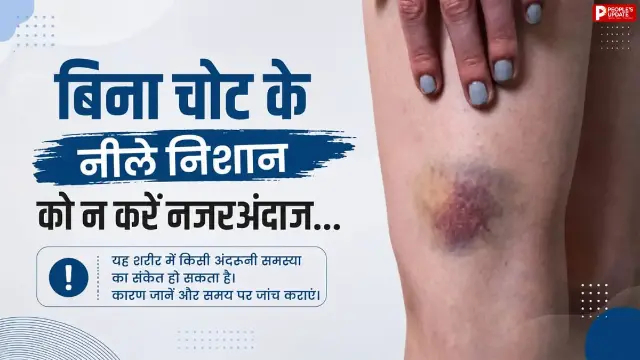 शरीर पर बिना चोट के पड़ रहे हैं नीले निशान? हो सकती है गंभीर बीमारी की चेतावनी