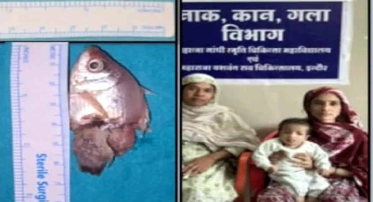मासूम के गले में फंसी जिंदा मछली, सर्जरी कर बचाई जान - Image 2
