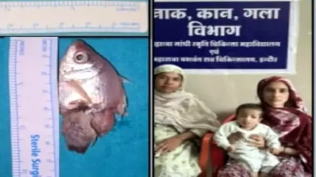 मासूम के गले में फंसी जिंदा मछली, सर्जरी कर बचाई जान