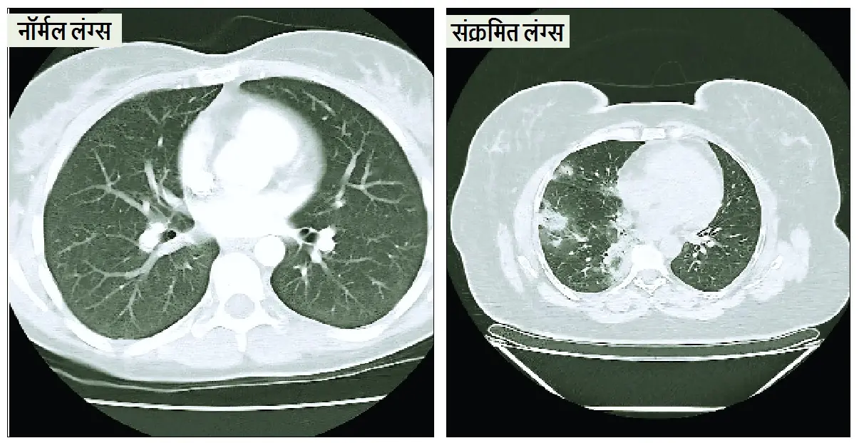 एडिनोवायरस-इन्फ्लुएंजा की दोहरी मार, निमोनिया और ब्रोंकाइटिस के मरीज बढ़े