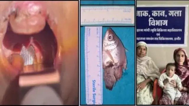 एक साल का बच्चा निगल गया जिंदा मछली, डॉक्टर्स ने जटिल ऑपरेशन कर बचाई मासूम की जिंदगी