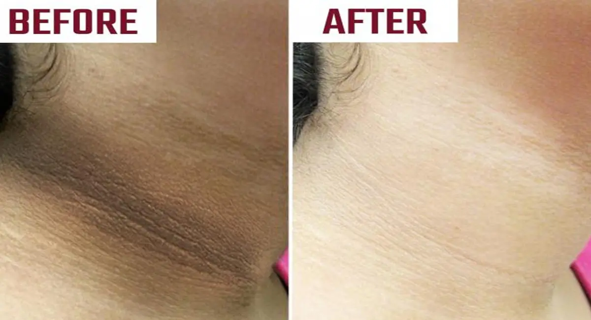 काली गर्दन को कहें अलविदा, टमाटर और कॉफी से पाएं निखार और नेचुरल ग्लोइंग स्किन