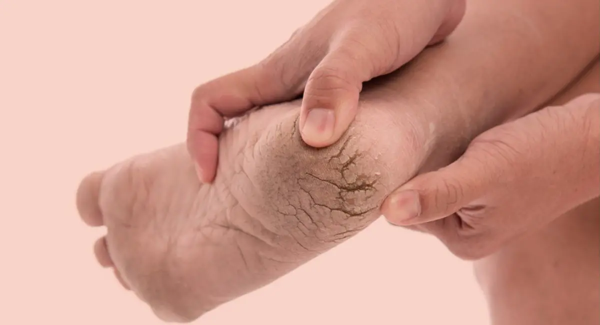 फटी एड़ियों की समस्या से क्या आप भी हैं परेशान, ये नेचुरल नुस्खा बदल देगा आपकी जिंदगी
